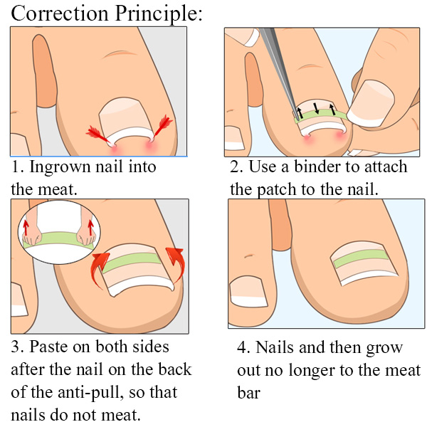 Ingrown-Toenail-Straightening-Clip-Curved-BS-Brace-Toenails-Thick-Paronychia-Correction-Tool-1154773